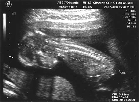 The Bub In The Belly Scan At 14 Weeks