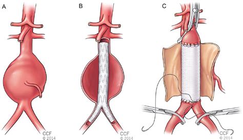 Vascular Disease Patient Information Page Abdominal Aortic Aneurysm