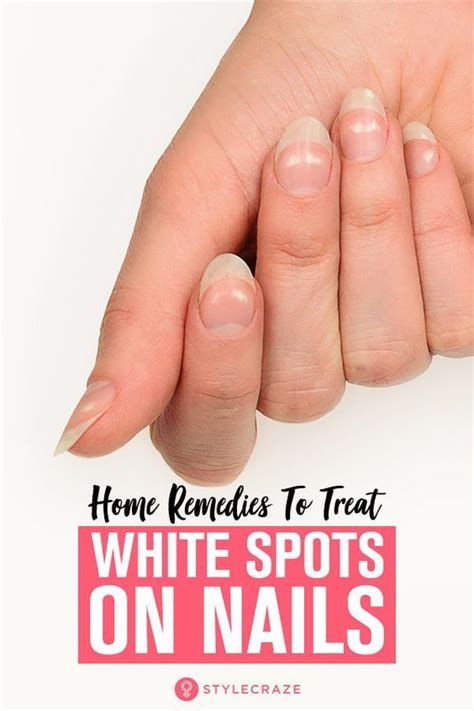 Treat White Spots On Nails With Home Remedies White Spots On Nails