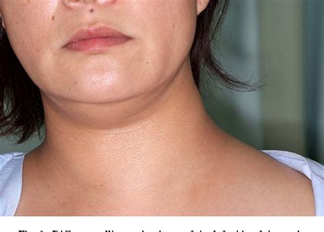 A Case Of Idiopathic Lymph Leakage In The Neck Semantic Scholar