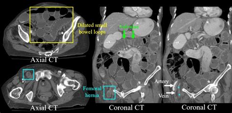 A femoral hernia results from internal tissues pushing through a weak point in the muscle wall, near the groin or inner thigh. RadiologySpirit: Femoral Hernia with Small Bowel Obstruction on CT Scans