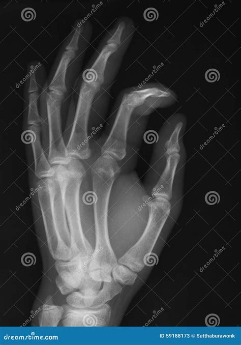 X Ray Image Of Hand Oblique View Stock Photo Image 59188173