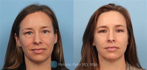 Co2 Laser Resurfacing Peel Before And After San Diego