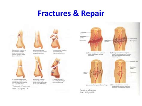 Ppt Fractures And Repair Powerpoint Presentation Free Download Id