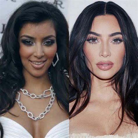 Kim Kardashian Before And After In Celebrity Surgery Celebrity