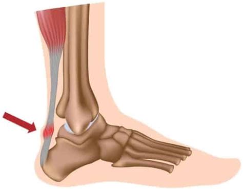 Achilles Tendinopathy And How To Fix It The Foot Pod