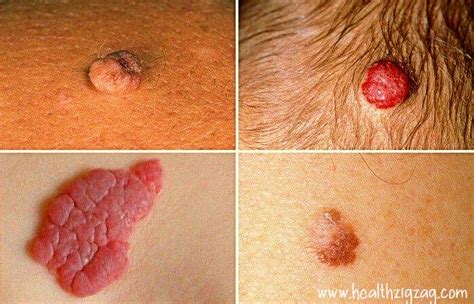 Moles tell a lot about a person's character, future, luck or misfortune. What Do The Red Moles On The Body Mean? - HealthZigZag