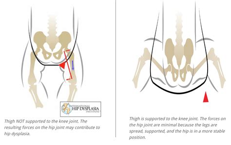 Car Seat For Baby With Hip Dysplasia