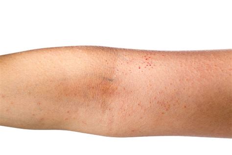 Exfoliative Dermatitis Stock Photos Pictures And Royalty Free Images