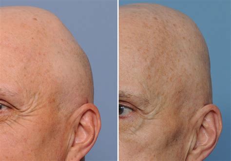 Plastic Surgery Case Study Custom Skull Implant For Coverage Of