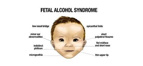 Fetal Alcohol Syndrome Or Fas What Is It How Serious Is Fas