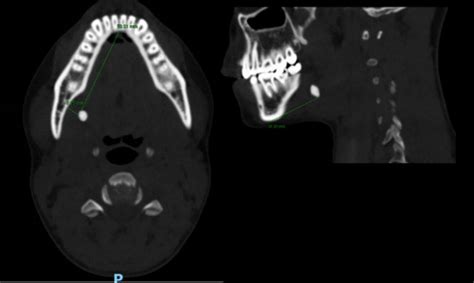 Computed Tomography Ct Of A Left Submandibular Gland Sialolith