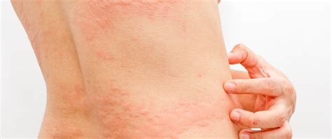 Cold Urticaria Symptoms Causes And How To Treat Being Allergic To Cold Healthy Herbs
