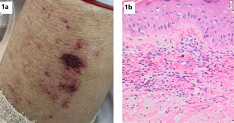 Papulopurpuric Rashes Seen Over The Limbs A Skin Biopsy B Shows