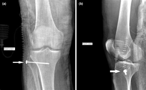 Postoperative A Anteroposterior And B Lateral Radiographs Show Open