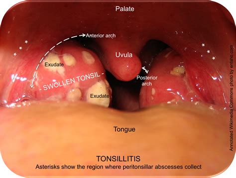 Tonsillitis —