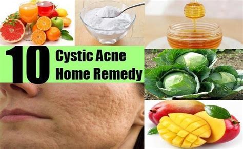 Cystic Acne Home Remedy The Best Acne Treatment