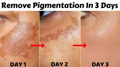 In 3 Days Remove Pigmentation Dark Spots And Acne Scars Easily At Home