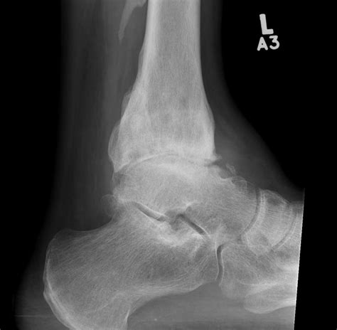 Ankle Osteoarthritis The Bone School