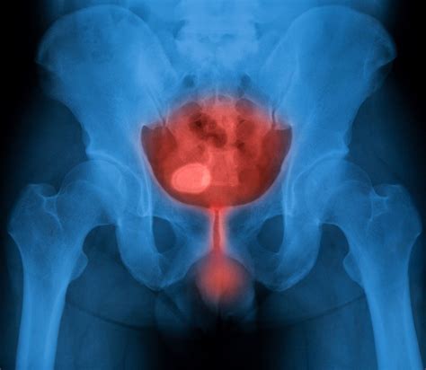 Ngu Non Gonococcal Urethritis Symptoms Treatment Std Ngu