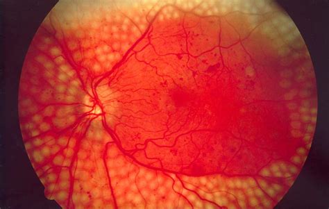 What Is Photocoagulation Treatment Retinarisk