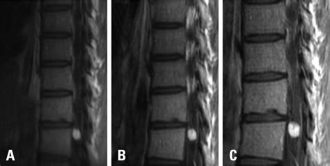 Illustration Of Tumor No2 A Initial Mri Showed Spinal Cord