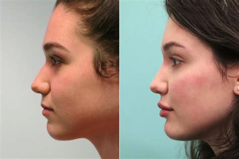 Cheeks Midface Injections Injections Laser Treatments Photos Chevy Chase Md Patient 18935