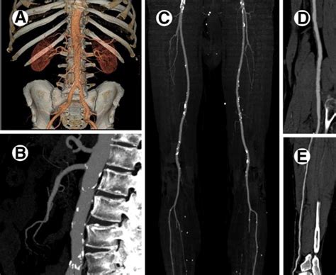 Ct Angiography Of Peripheral Arterial Occlusive Disease Techniques In