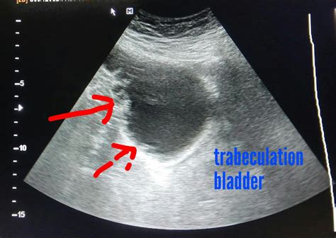 Ultrasound Imaging Urinary Bladder Trabeculation 3d Ultrasound
