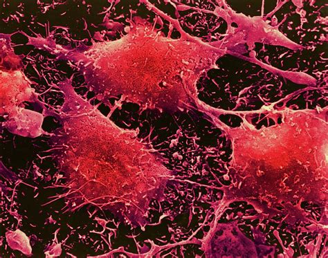 Human Brain Cancer Cells Photograph By Dennis Kunkel Microscopyscience