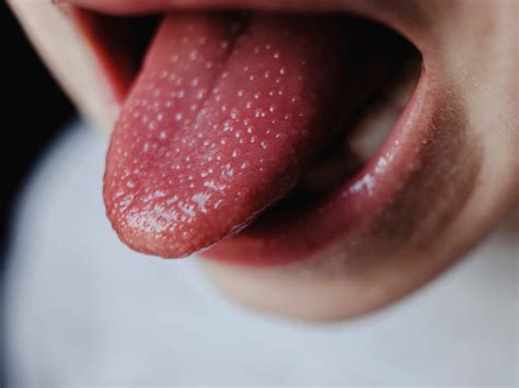 Curing Acid Bumps On Tongue