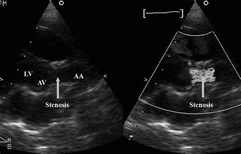 Supravalvular Aortic Stenosis Circulation Cardiovascular Genetics