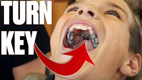 Getting Braces For The First Time Expander With Turning Key Making Room For More Teeth Youtube