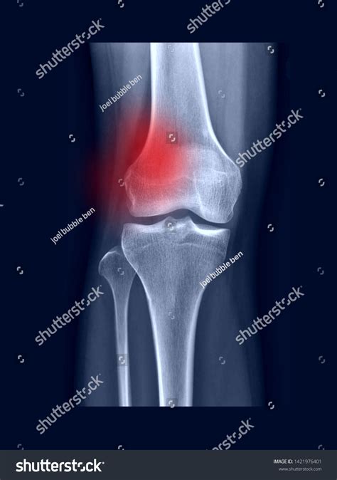 Film Xray Knee Radiograph Show Normal Stock Photo 1421976401 Shutterstock