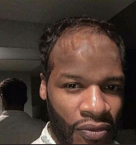 Top 20 Worst Hairlines Of All Time