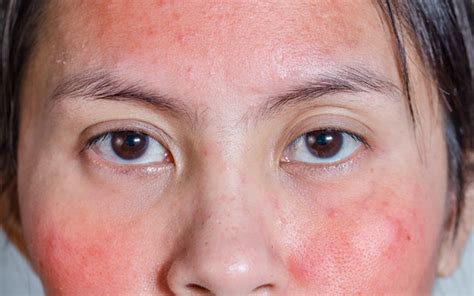 Redness On Face 15 Causes And 8 Ways To Reduce It Skinkraft