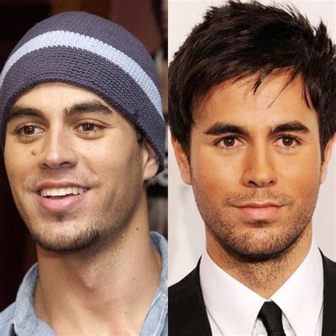 Enrique Iglesias Mole Before And After