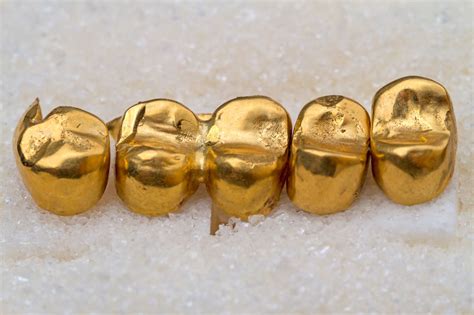 What Is A Gold Dental Crown