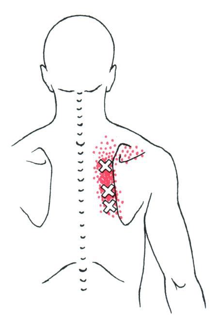 Rhomboid The Trigger Point And Referred Pain Guide