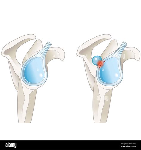 A Slap Lesion Paralabral Cyst In The Shoulder Is A Tear In The Labrum