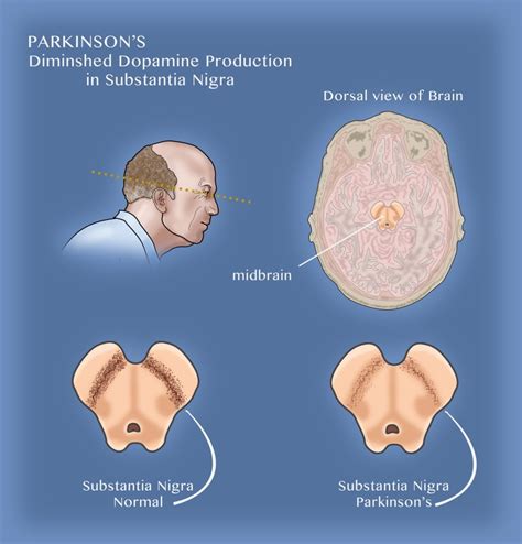 Substantia Nigra And Parkinsons Disease Poster Print By Monica Schroeder