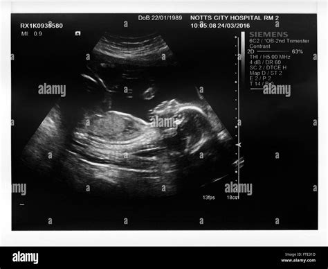 Ultrasound Baby Boy High Resolution Stock Photography And Images Alamy