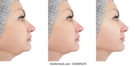 Woman Chin Lift Before After Procedures Stock Photo 1310495675