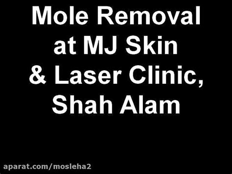 Mole Removal At Mj Skin Laser Clinic