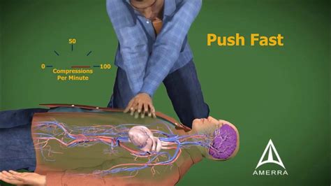 Cpr Cardiopulmonary Resuscitation 3d Animation Youtube