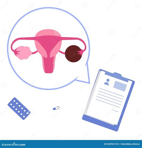 Ovarian Cyst Vector Illustration Labeled Medical Condition Types