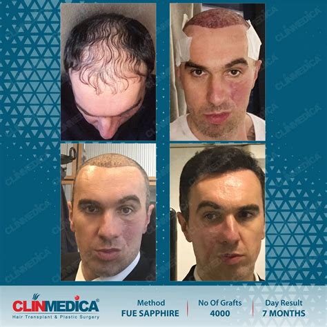 The Definitive Guide To Fue Hair Transplant Turkey