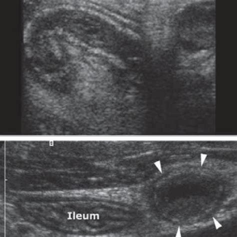 Pdf Role Of Graded Compression Ultrasonography In Evaluation Of Acute