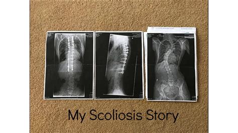 My Scoliosis Story Youtube