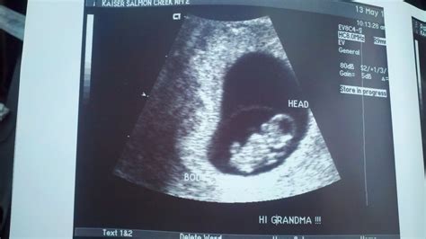 Stay hydrated and graze on healthy. Parsons' Bebe: Ultrasound-8 Weeks